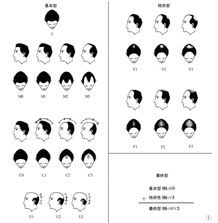 脂溢性脱发的BASP分型法_《中国美容整形外科杂志》_阅微基因