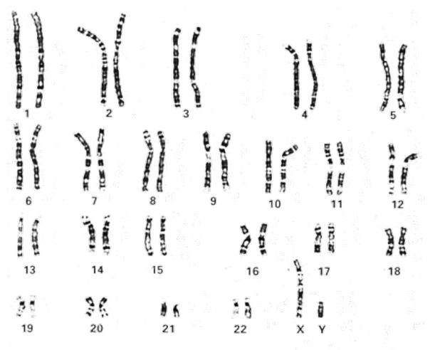 G显带核型分析图 图源ISCN_一文读懂染色体核型分析_阅微基因